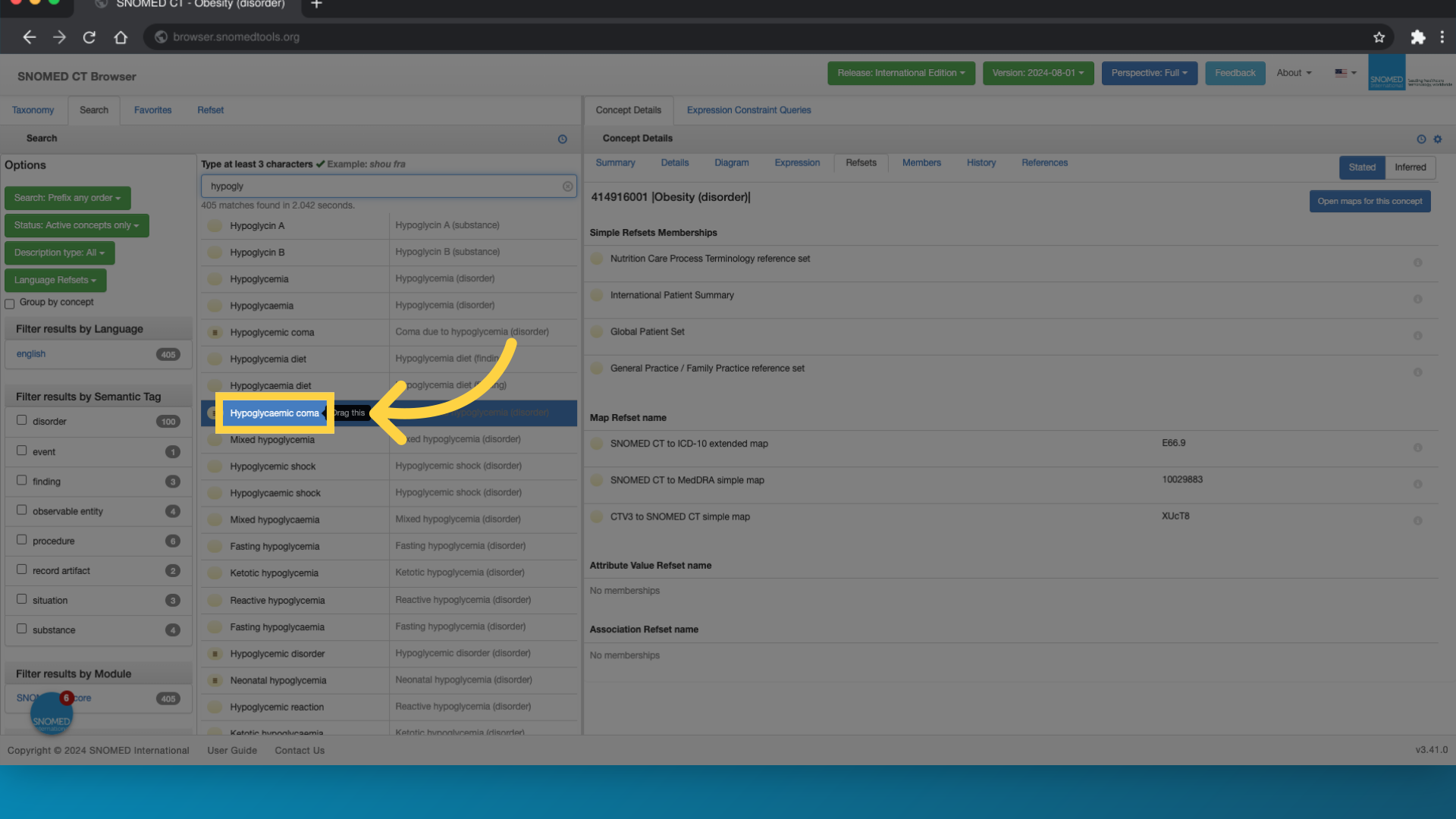 In this example, the concept 'Hypoglycaemic coma' is selected